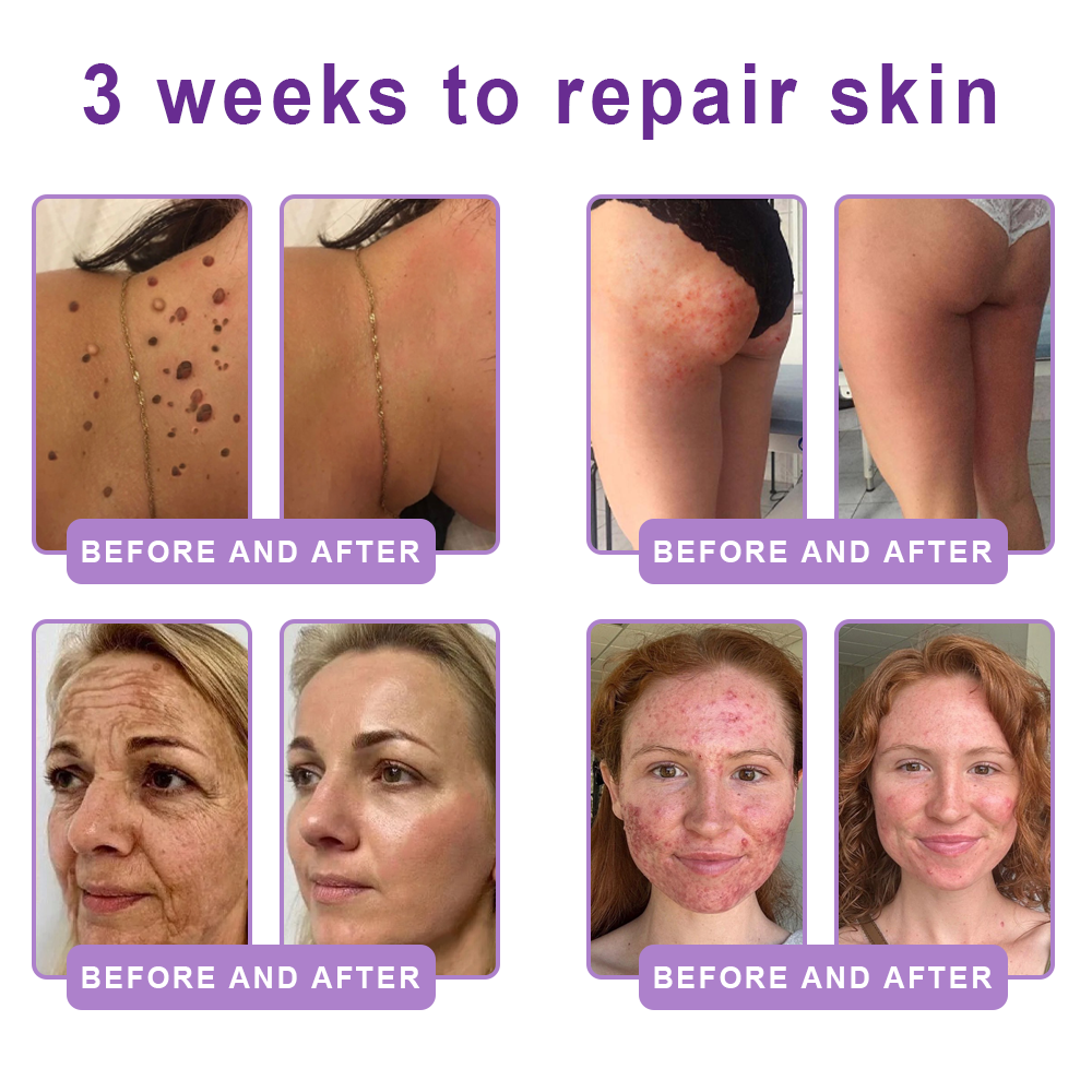𝐋𝐮𝐦𝐨𝐫𝐢𝐞® PDRN💎 Multi-Peptide Massaging Body Roller Cream- Anti-aging, Hydrating, Skin Firming & Lifting, Skin Repair, Even Tone, Acne and Dark Spot Treatment, Wart and Mole Removal, and Psoriasis Relief.