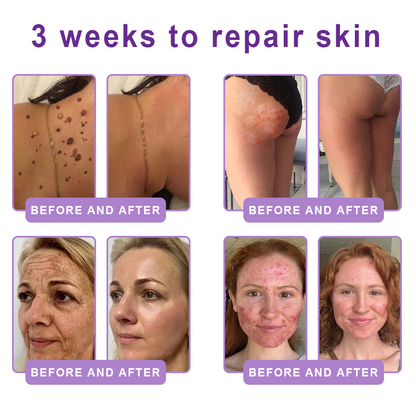 𝐋𝐮𝐦𝐨𝐫𝐢𝐞® PDRN💎 Multi-Peptide Massaging Body Roller Cream- Anti-aging, Hydrating, Skin Firming & Lifting, Skin Repair, Even Tone, Acne and Dark Spot Treatment, Wart and Mole Removal, and Psoriasis Relief.