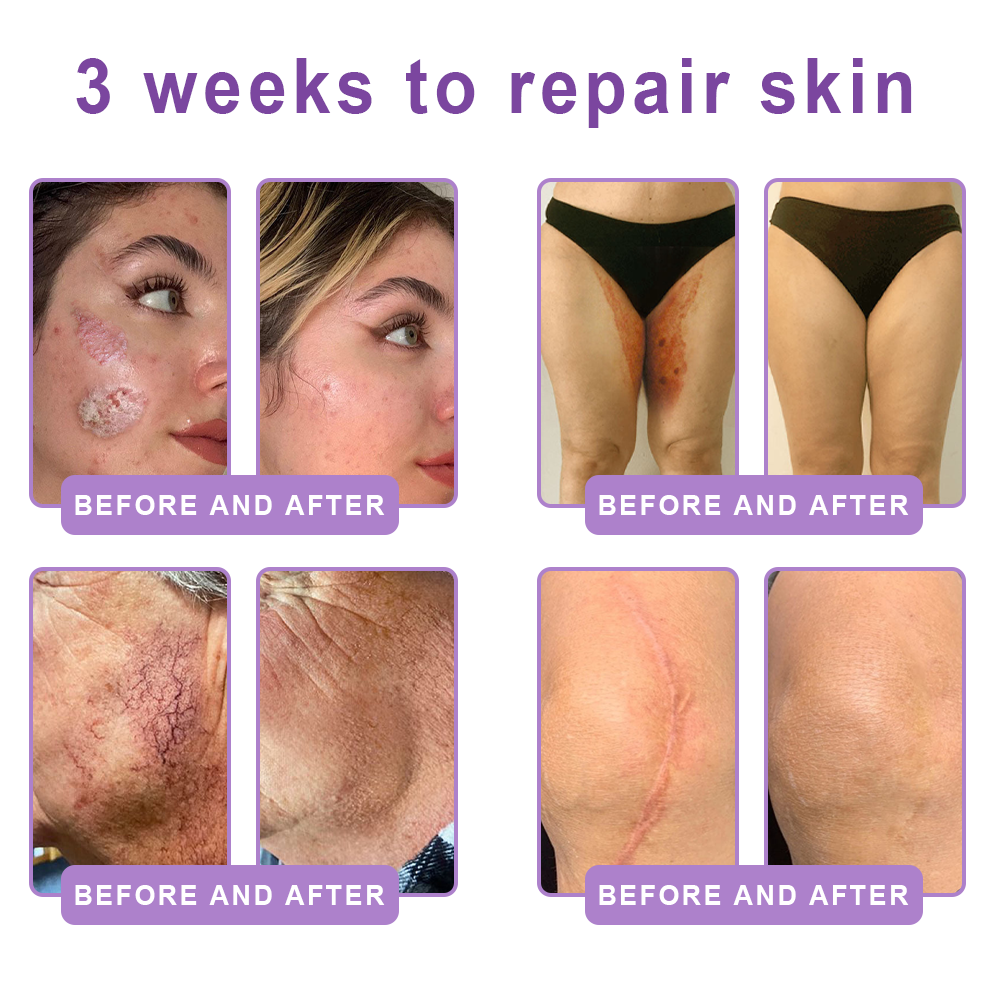 𝐋𝐮𝐦𝐨𝐫𝐢𝐞® PDRN💎 Multi-Peptide Massaging Body Roller Cream- Anti-aging, Hydrating, Skin Firming & Lifting, Skin Repair, Even Tone, Acne and Dark Spot Treatment, Wart and Mole Removal, and Psoriasis Relief.