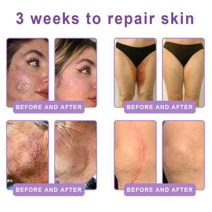 𝐋𝐮𝐦𝐨𝐫𝐢𝐞® PDRN💎 Multi-Peptide Massaging Body Roller Cream- Anti-aging, Hydrating, Skin Firming & Lifting, Skin Repair, Even Tone, Acne and Dark Spot Treatment, Wart and Mole Removal, and Psoriasis Relief.