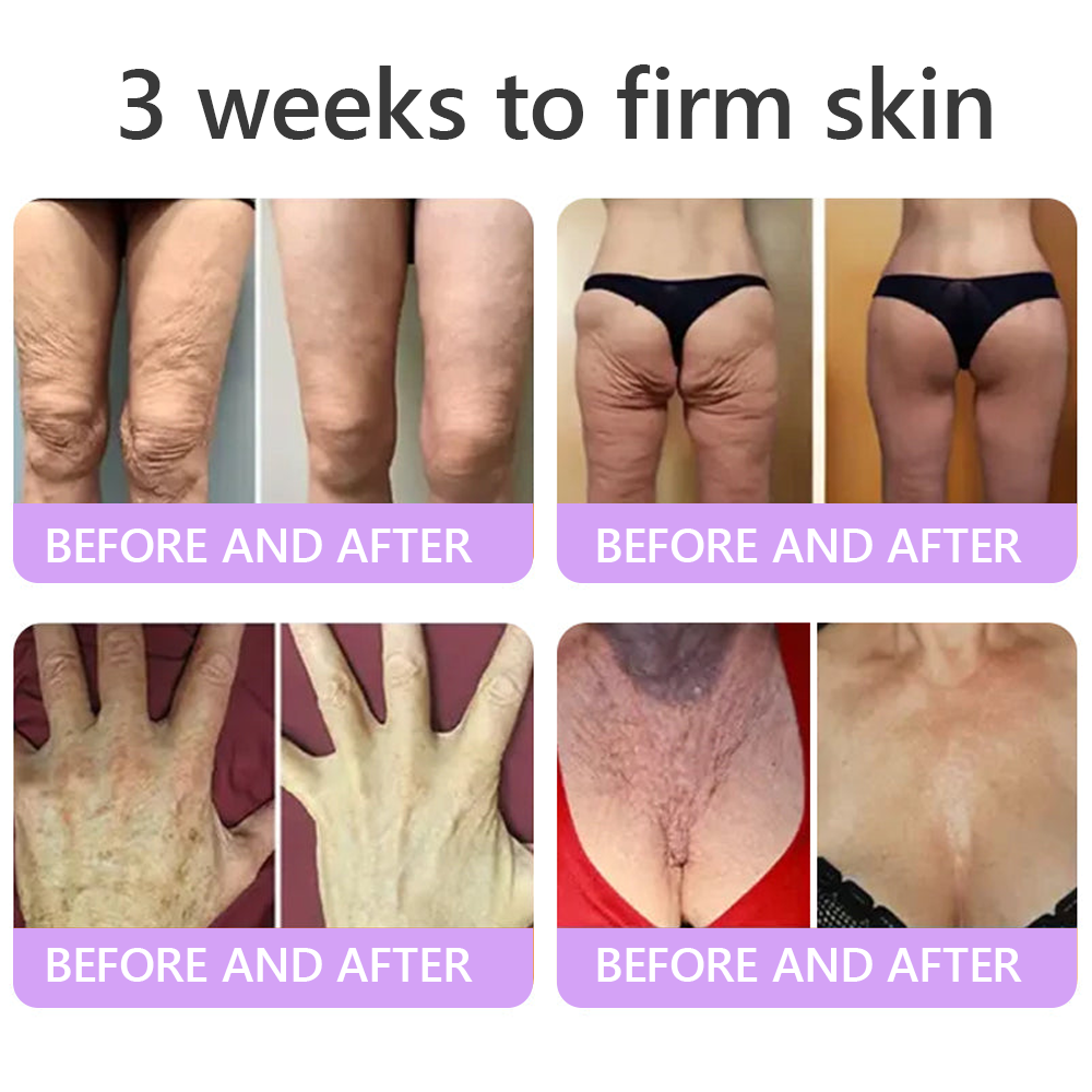 𝐋𝐮𝐦𝐨𝐫𝐢𝐞® PDRN💎 Multi-Peptide Massaging Body Roller Cream- Anti-aging, Hydrating, Skin Firming & Lifting, Skin Repair, Even Tone, Acne and Dark Spot Treatment, Wart and Mole Removal, and Psoriasis Relief.