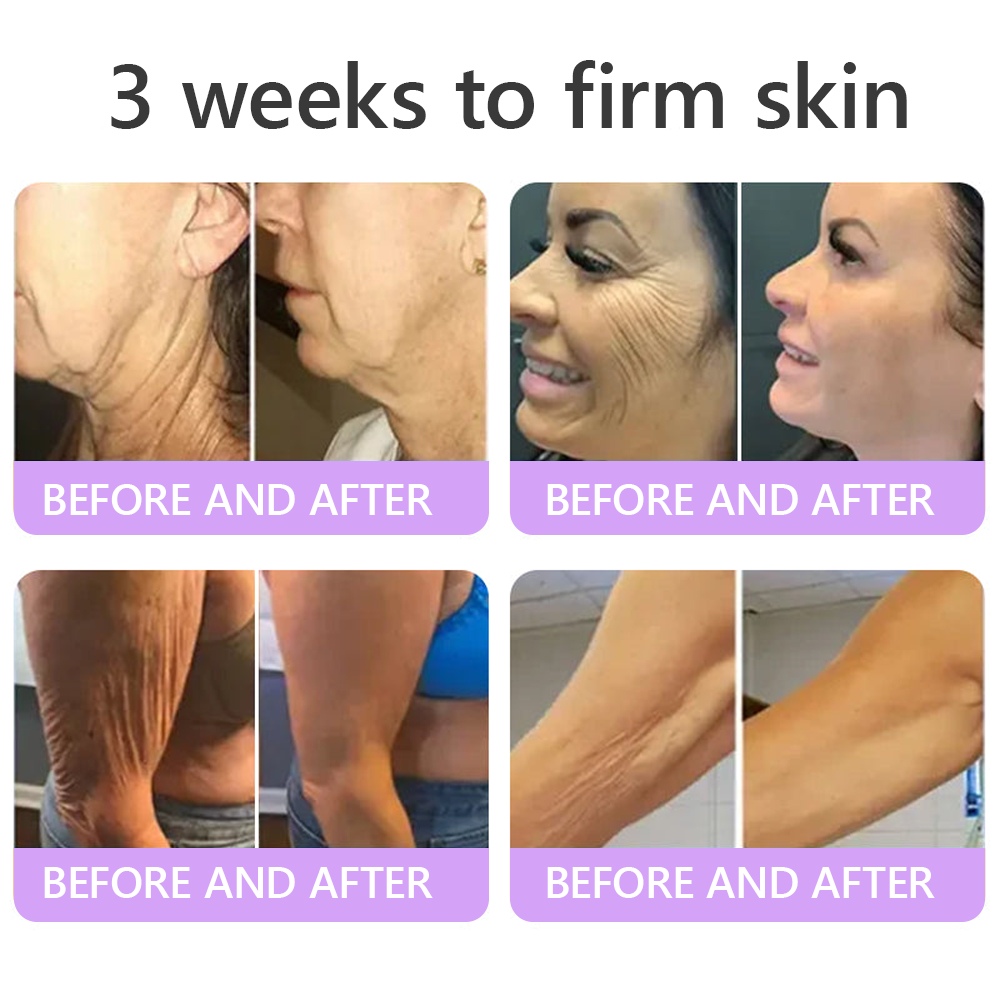 𝐋𝐮𝐦𝐨𝐫𝐢𝐞® PDRN💎 Multi-Peptide Massaging Body Roller Cream- Anti-aging, Hydrating, Skin Firming & Lifting, Skin Repair, Even Tone, Acne and Dark Spot Treatment, Wart and Mole Removal, and Psoriasis Relief.